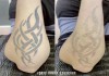 Фото Лазерное удаление татуировок и татуажа