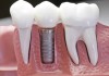 Фото Имплантация и лечение зубов недорого