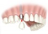Имплантация зубов в москве