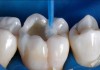 Фото Восстановление стершихся зубов