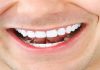 Фото Отбеливания зубов в домашних условиях White Light