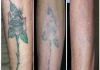 Удаление татуировок, татуажа лазером без шрамов и рубцов