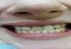 Фото Лечение пародонтоза и лучшие зубные протезы.